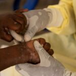 Mpox: saiba quais doenças já tiveram mais alto nível de alerta global