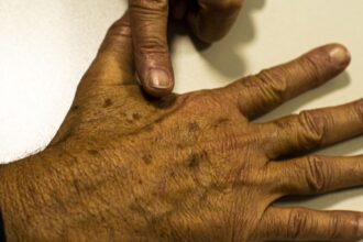 Câncer de pele gera R$ 4,6 mi em custos hospitalares em quase 2 anos