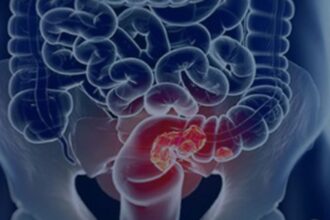 Estudo projeta aumento de 36% em mortes por câncer colorretal até 2040