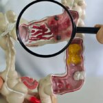 Em 13 anos, doença inflamatória intestinal cresce 5 vezes no Brasil