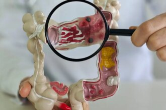 Em 13 anos, doença inflamatória intestinal cresce 5 vezes no Brasil