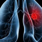 Saiba o que é adenocarcinoma pulmonar, câncer que atinge o Papa Leão XIV