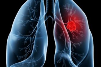 Saiba o que é adenocarcinoma pulmonar, câncer que atinge o Papa Leão XIV