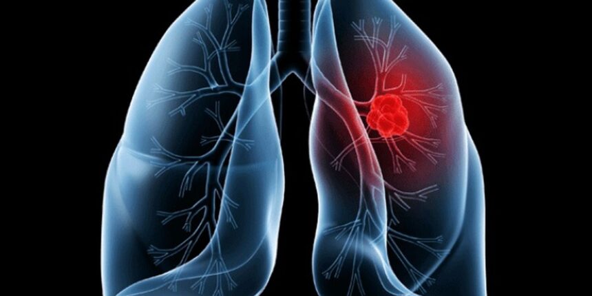 Saiba o que é adenocarcinoma pulmonar, câncer que atinge o Papa Leão XIV